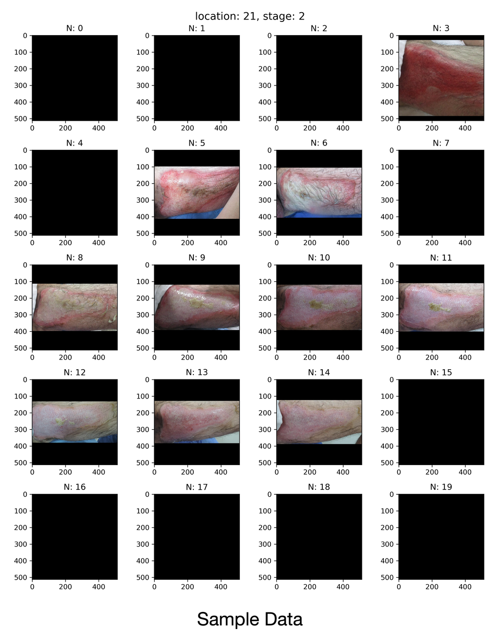Burn wound image example used for severity and area analysis